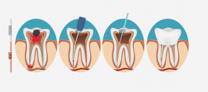 Endodontic Retreatment